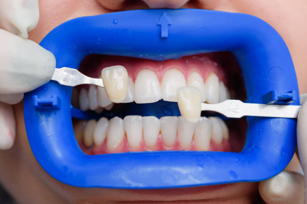 Close-up of a dental professional using a shade guide to match tooth color during a dental restoration procedure.