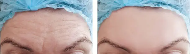 A comparison image showing the forehead before and after reduction surgery, highlighting the smoother and lower hairline.