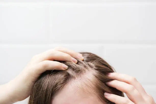 Close-up of a scalp showing thinning hair, linked to Magnesium L-Threonate benefits for hair loss.