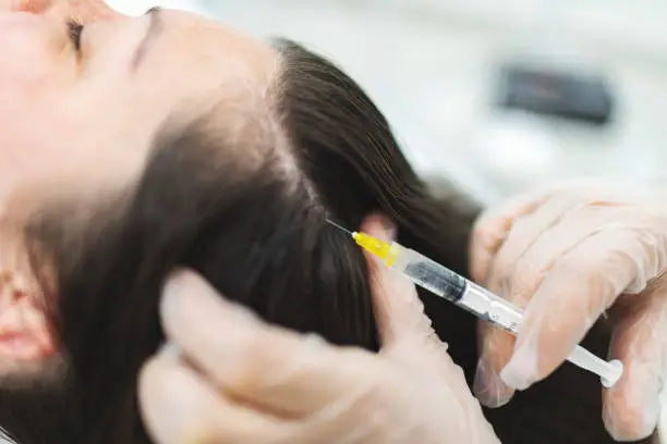 A professional administering an injection into the scalp, a treatment option for hair loss.