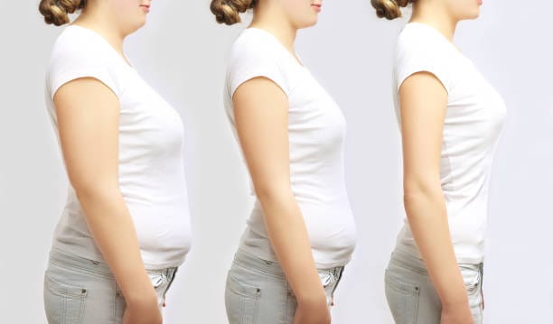 Three side-by-side images showing a woman’s transformation with reduced fat and improved posture.